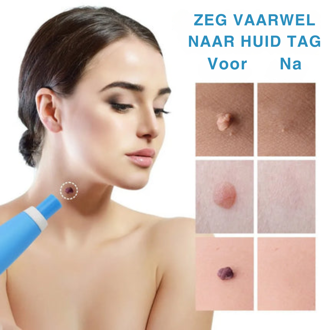 SkinClear De pijnloze manier naar een zijdezachte huid.