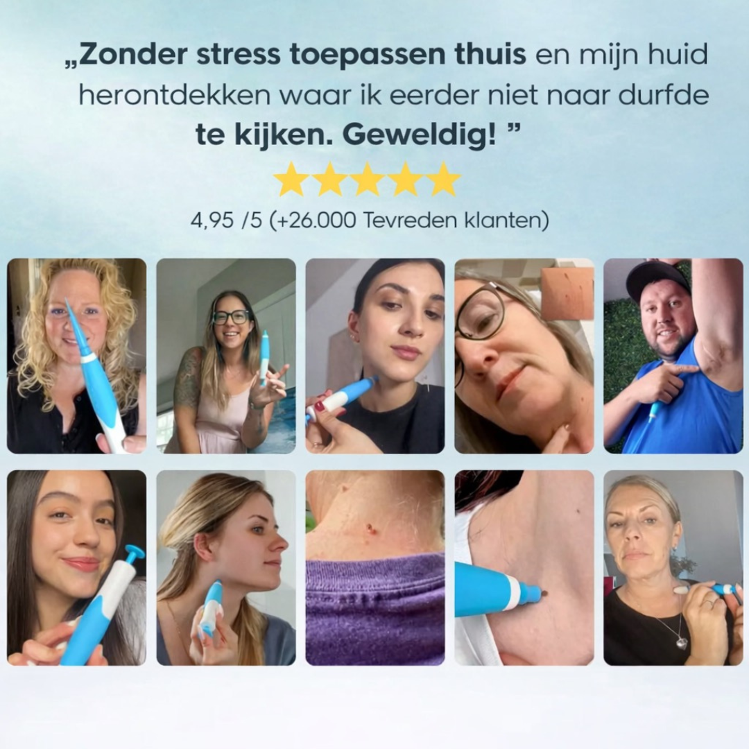 DermaLuxe Huidtag Verwijderaar - Veilig Thuis