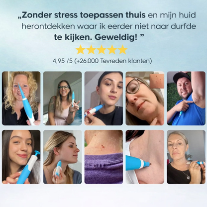 DermaLuxe Huidtag Verwijderaar - Veilig Thuis